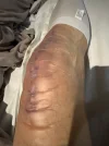 [Bonesmart.org] Knee Scars - Post Your Badges of Honor Here! NO CHIT-CHAT please