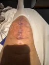 [Bonesmart.org] Knee Scars - Post Your Badges of Honor Here! NO CHIT-CHAT please