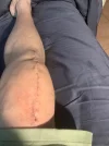 [Bonesmart.org] Knee revision “1st night”