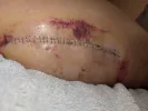 [Bonesmart.org] Hippies scars - post your badges of honor here: NO CHIT-CHAT HERE PLEASE