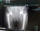[Bonesmart.org] Balancing Exercise & Hip Health Prior to Revision Surgery