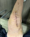 [Bonesmart.org] Knee Scars - Post Your Badges of Honor Here! NO CHIT-CHAT please