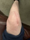 [Bonesmart.org] Knee Scars - Post Your Badges of Honor Here! NO CHIT-CHAT please