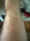 [Bonesmart.org] Knee Scars - Post Your Badges of Honor Here! NO CHIT-CHAT please