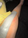 [Bonesmart.org] Reader's Left TKR Spacer Exchange