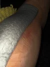 [Bonesmart.org] Reader's Left TKR Spacer Exchange