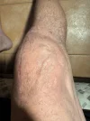 [Bonesmart.org] Knee revision “1st night”