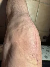 [Bonesmart.org] Knee revision “1st night”