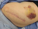 [Bonesmart.org] Hippies scars - post your badges of honor here: NO CHIT-CHAT HERE PLEASE
