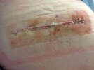 [Bonesmart.org] Hippies scars - post your badges of honor here: NO CHIT-CHAT HERE PLEASE