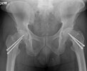 [Bonesmart.org] bilateral THR 10/22/12