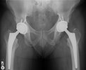[Bonesmart.org] bilateral THR 10/22/12