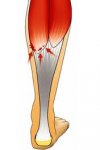 [Bonesmart.org] Replacement Knee is Warm