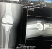 [Bonesmart.org] my knee on the other side