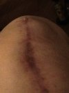 [Bonesmart.org] Story of My Knees by RestAssured: Pt 3