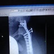 Arthrodesis13