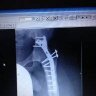 Arthrodesis13